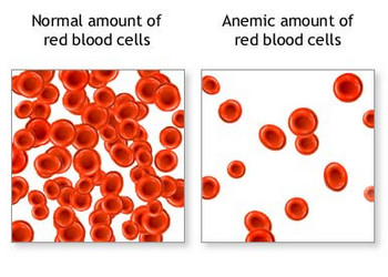 chung-thieu-mau-o-cho-anemia